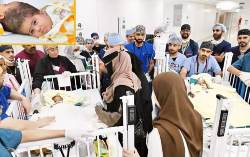 സയാമീസ് ഇരട്ടകളുടെ വേർപെടുത്തൽ ശസ്ത്രക്രീയ വിജയകരം