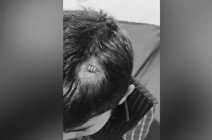 അധ്യാപിക ടിഫിൻ ബോക്സ് എറിഞ്ഞു: എൽകെജി വിദ്യാർത്ഥിയുടെ തലക്ക് പരുക്ക്