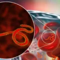 ebola